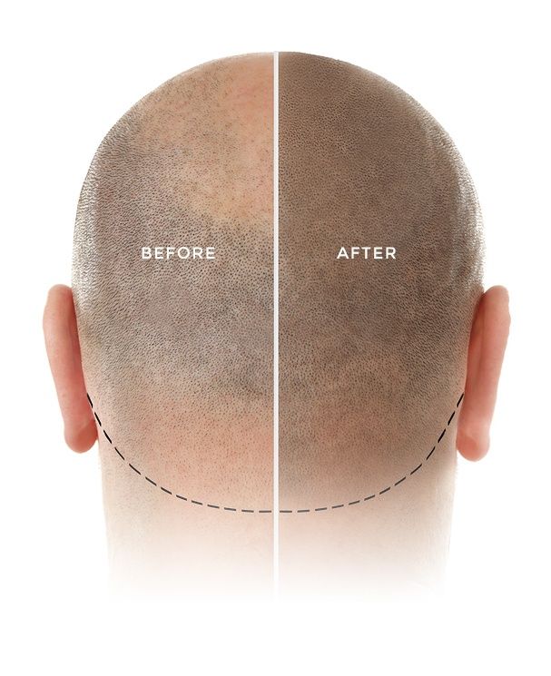 img2 Kiierr Laser Hair Caps Hair Growth Experts