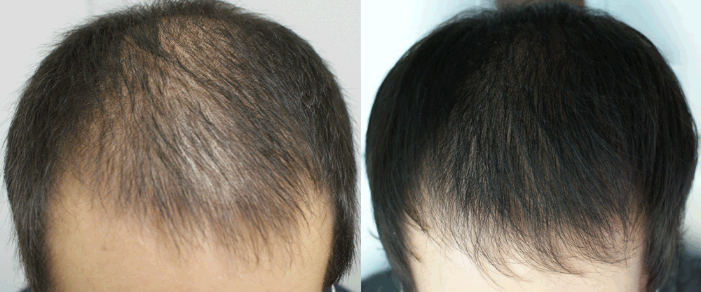 Do Laser Caps Help Hair Regrowth