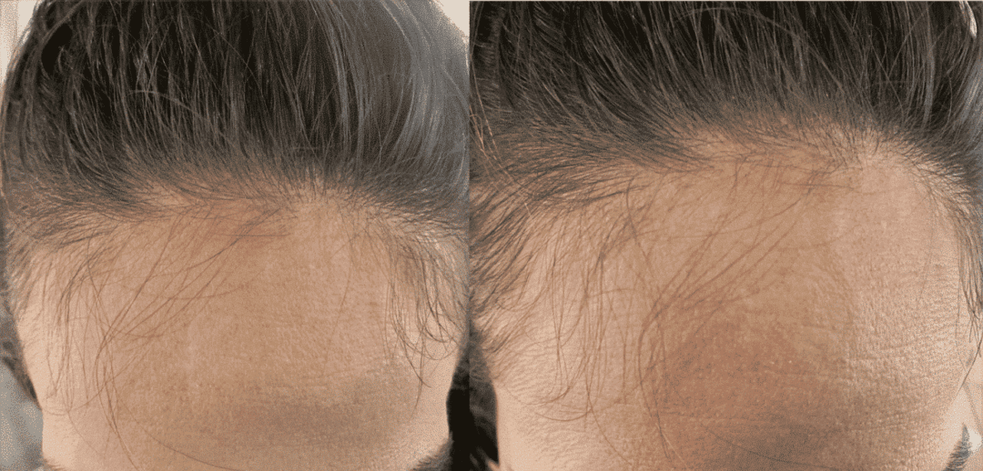 laser cap for hair growth