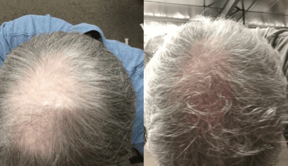 Do Laser Caps Help Boost Hair Growth? Kiierr Laser Hair Caps