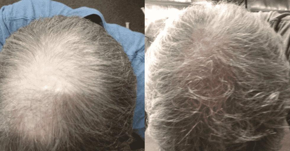 Do Laser Caps Work For Hair Loss? [Updated Aug. 2022]