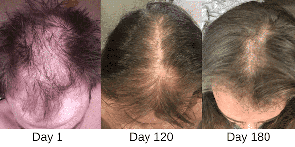 Kiierr Laser Cap Review - before and after hair growth image (1)