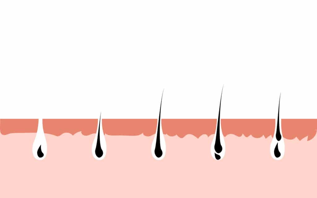 Traitement par laser pour la croissance des cheveux : Comment et pourquoi ça marche