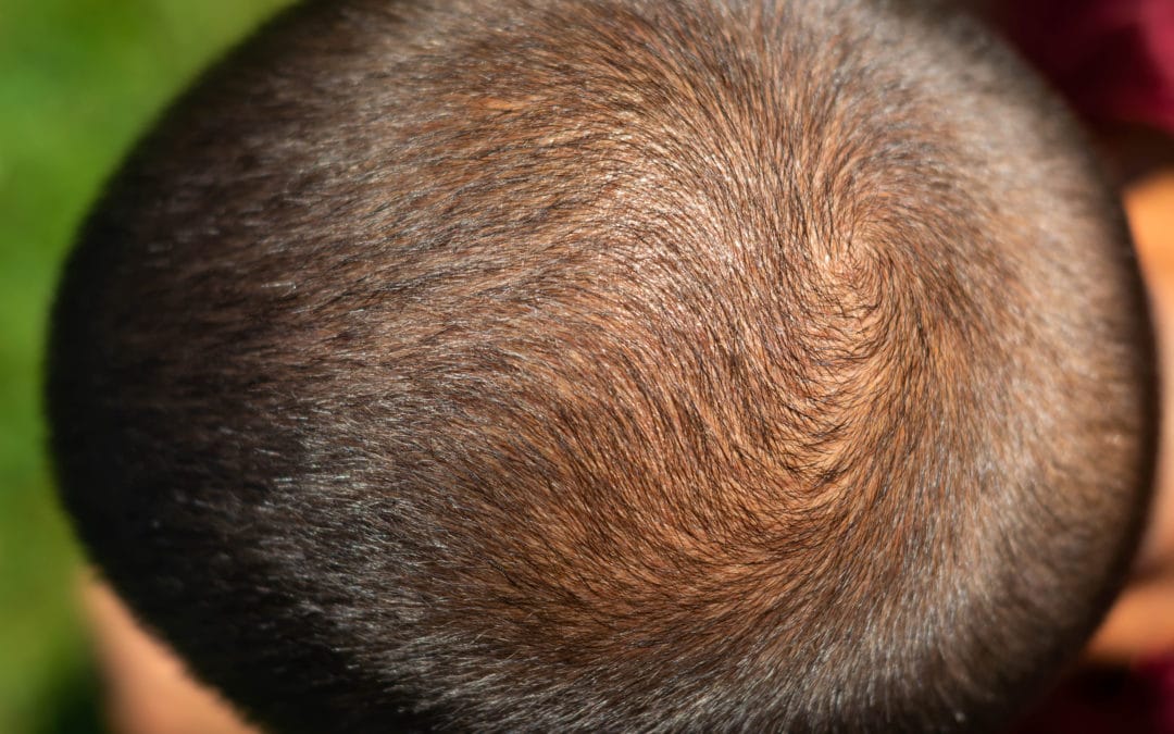 Is There Really a Hat That Grows Hair?