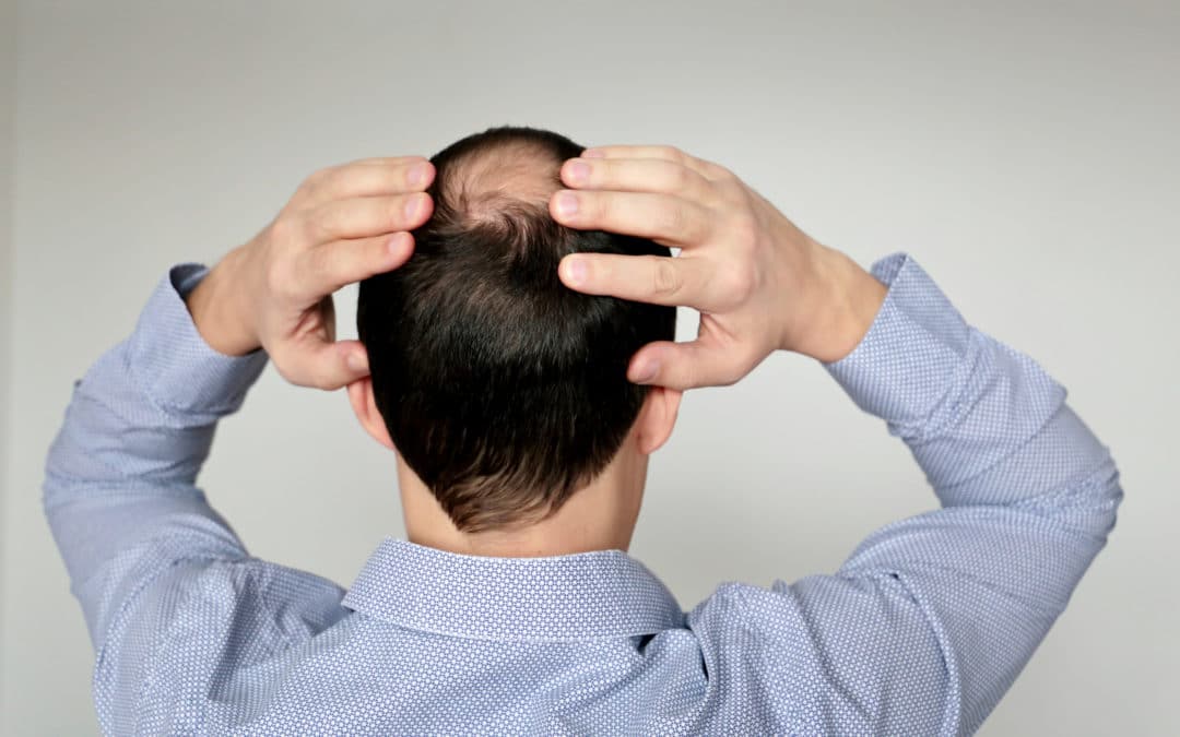 Home Remedies for Hair Loss
