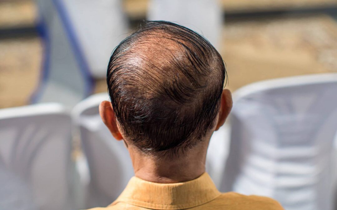 Do I Have Male or Female Pattern Baldness? - Kiierr