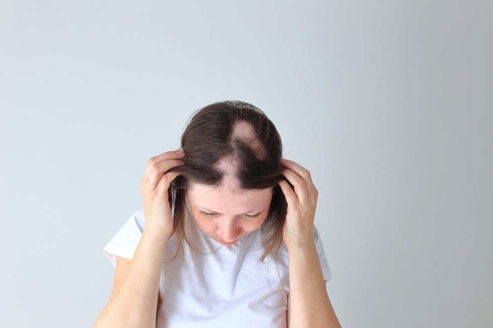 Medications That Cause Hair Loss Reveal the Top 17