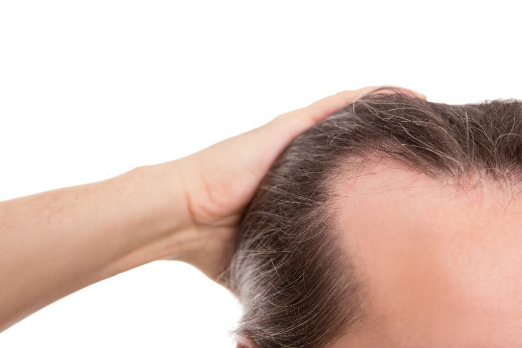 receding hairline causes