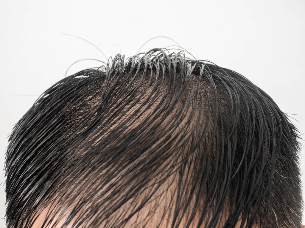 shampoo for hair loss prevention