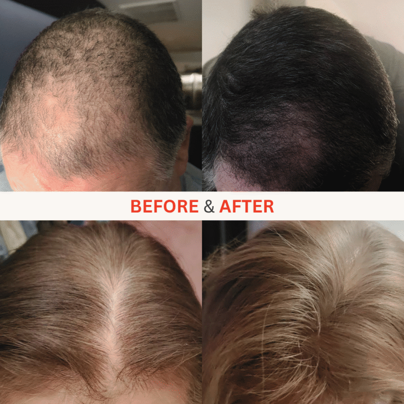 272 MD Elite Laser Hair Cap - Ultimate MAX Growth Bundle - Image 4
