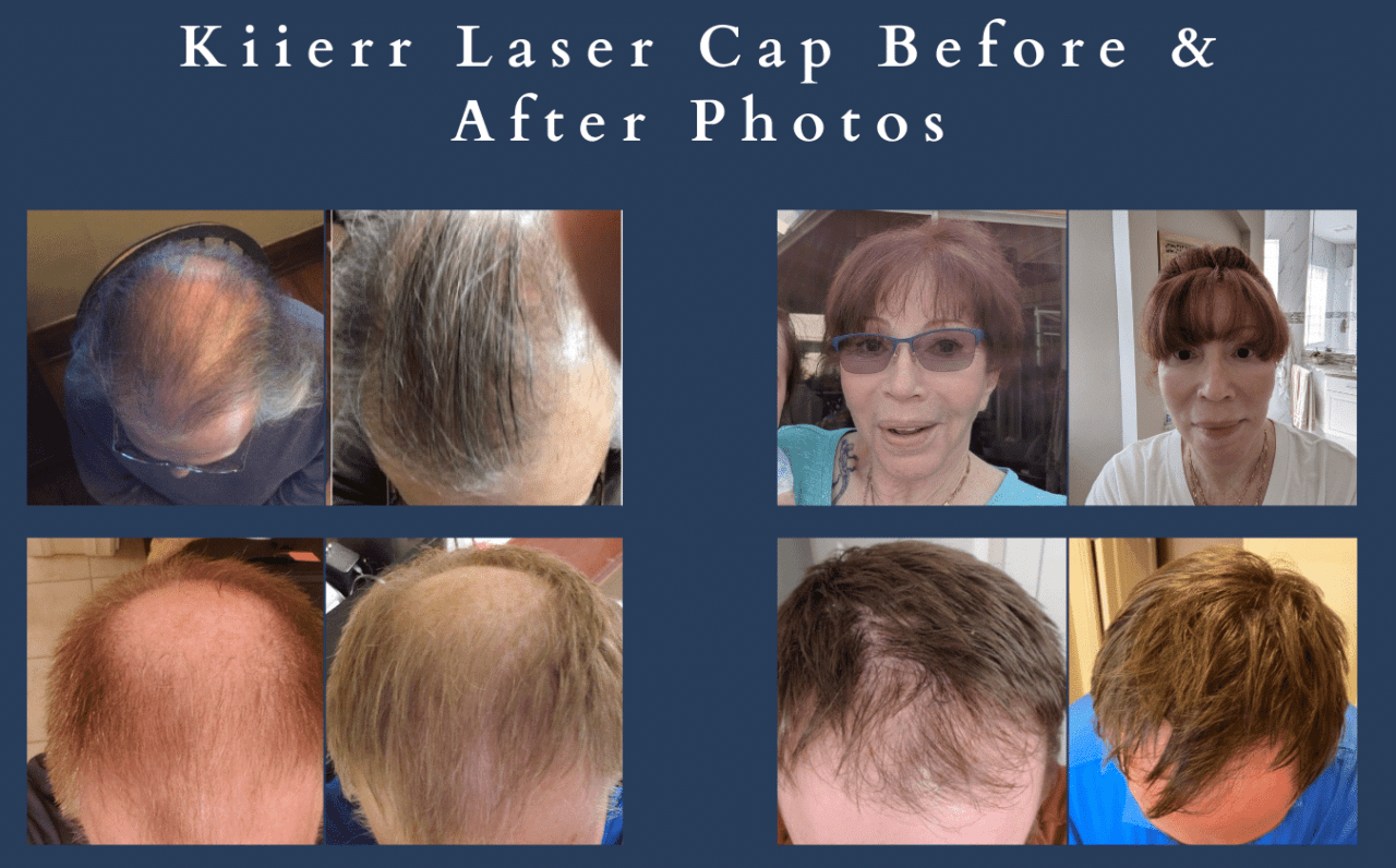 Can people with darker skin types use laser caps? Kiierr Laser Hair