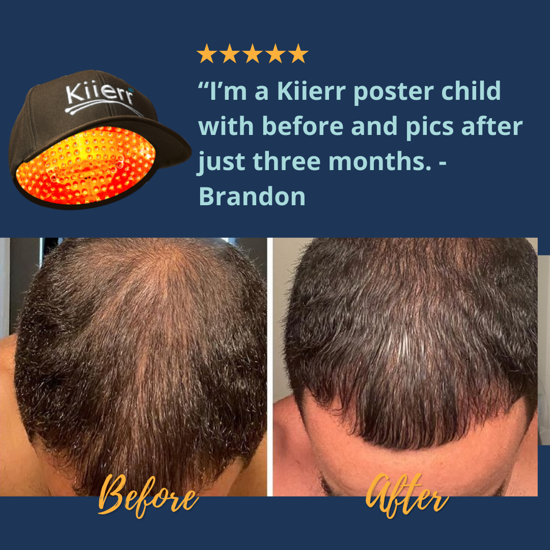 Can People With Darker Skin Types Use Laser Caps Kiierr Laser Hair Caps Hair Growth Experts 7075