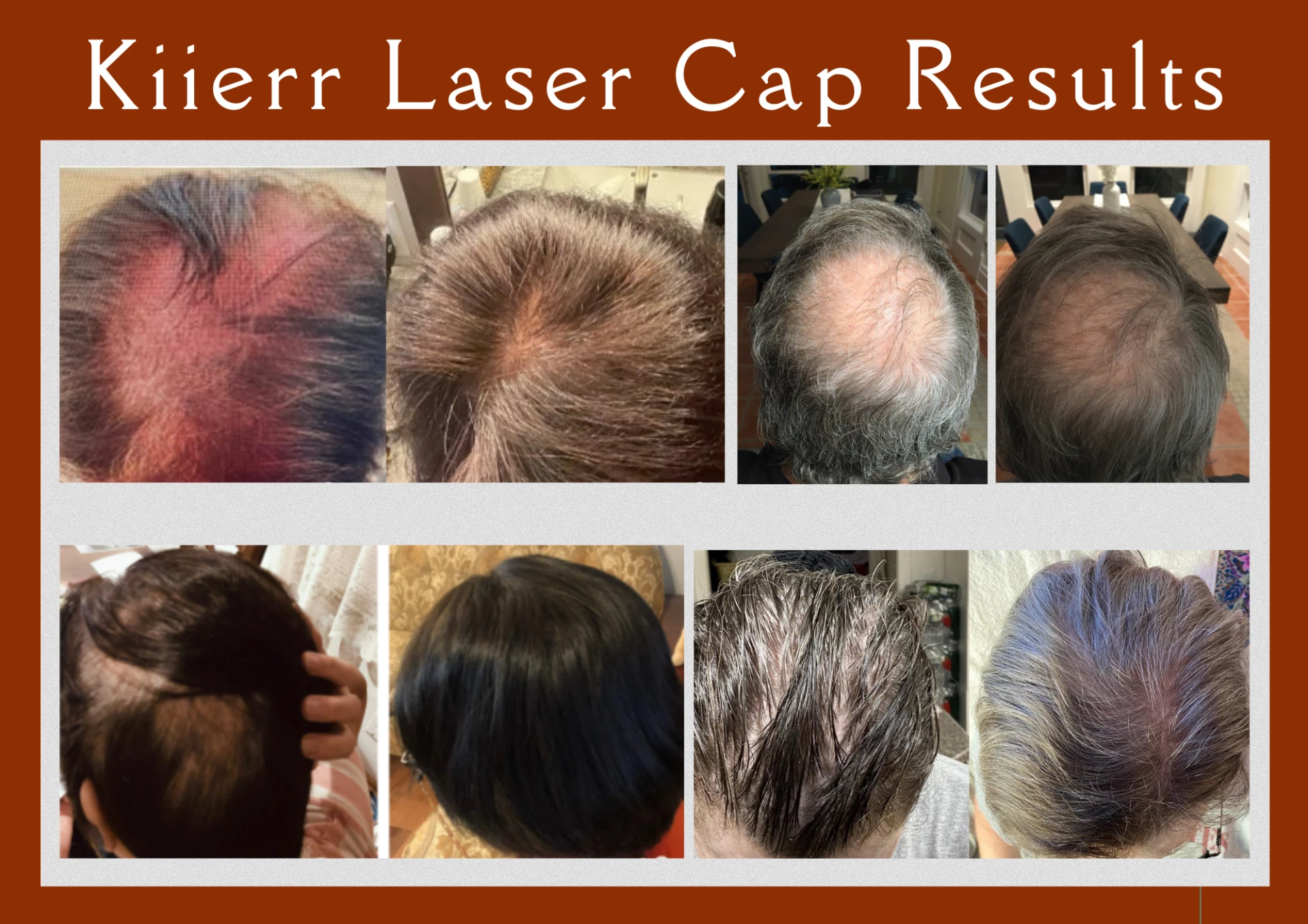 Kiierr Laser Cap real results from real customers