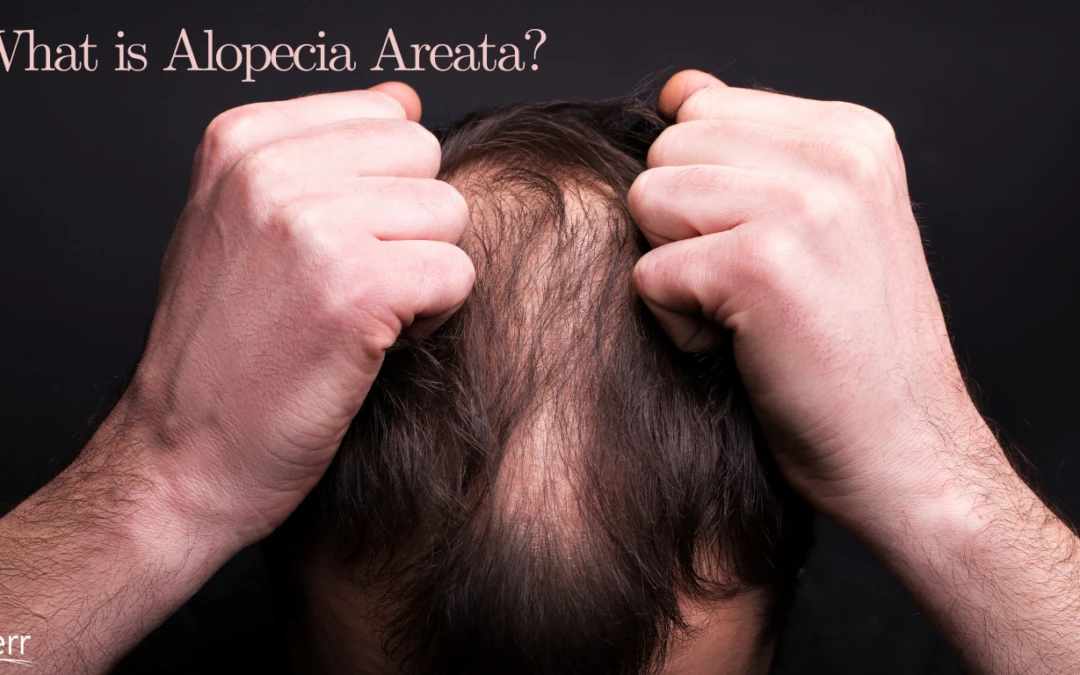 What Is Alopecia Areata And Can It Be Treated?